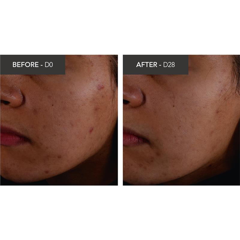 Kem dưỡng ẩm Bioderma Sebium Kerato Nonallergenic Acne Cream phù hợp với da mụn 30ml 
